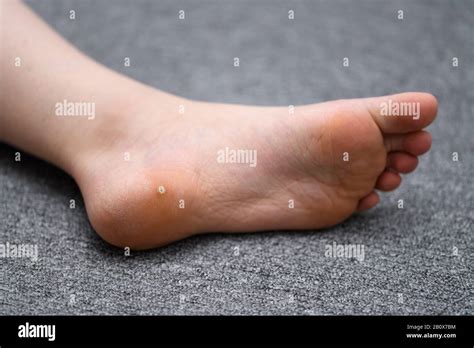 Verrucas Plantar Hi Res Stock Photography And Images Alamy