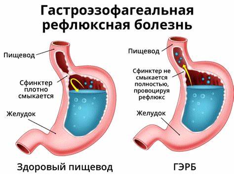 Эзофагит лечение диета симптомы Эрозивный эзофагит: лечение, препараты, народные средства - ГБУЗ МО Эрозивный эзофагит: лечение, препараты, народные средства - ГБУЗ МО Эзофагит лечение диета симптомы