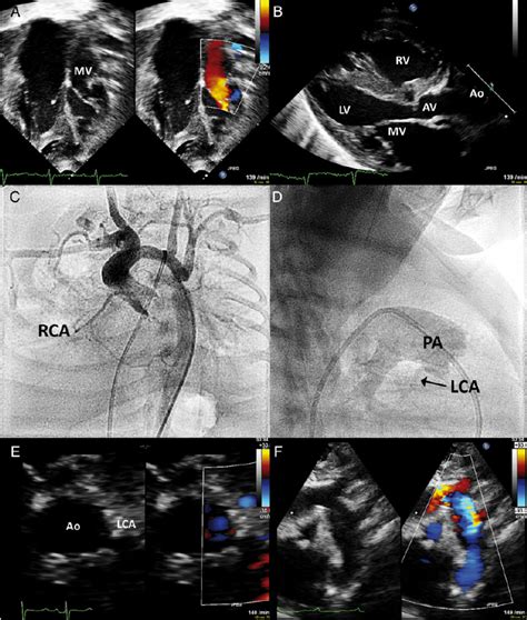Preoperative And Postoperative Images Of Transthoracic Echocardiography
