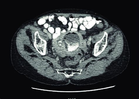 ct scan showing the uterine cavity filled with fluid air and oral download high quality