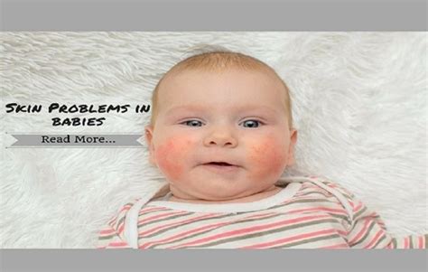 Babies Skin Problems Ayurvedic Treatment For Eczema In Babies