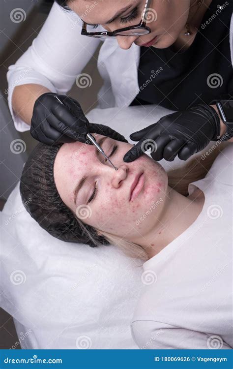 Mechanical Facial Cleansing Stock Photo Image Of Medical Irritation