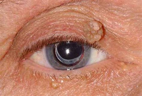 Eyelid Lesion Removal Advanced Eye Institute Richard L Arceneaux M