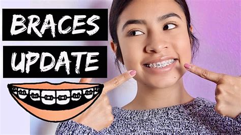 Braces Update 20 Months Youtube
