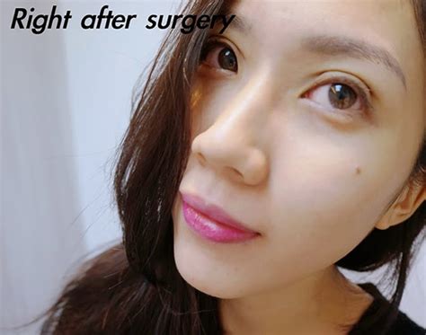 What Kind Of Double Eyelid Profile Should You Have Double Eyelids Surgery In Singapore