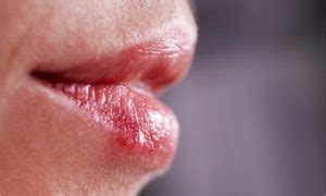 Hiv Symptoms In Mouth What You Need To Know