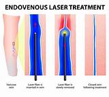 Pictures of Endovenous Laser Treatment