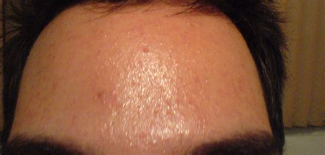 Pimples Only On Forehead Adult Acne Community