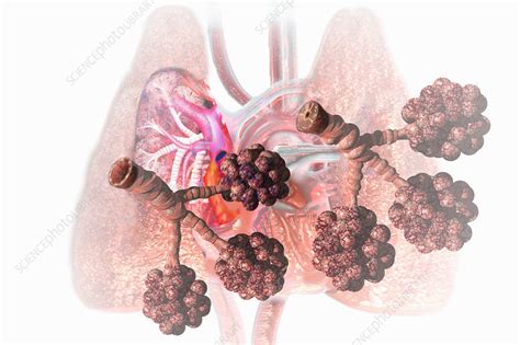 Mucus Filling Up Lungs