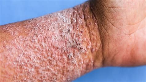 Tralokinumab Achieves Nodule For Atopic Dermatitis In Europe