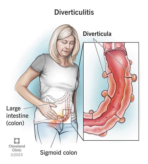Complications Of Diverticulitis Diverticulitis Inflammation Cavities The Best Porn Website