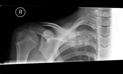 Clavicular Swelling—classic Presentation Of Chronic Non Bacterial