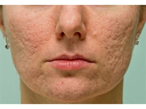 How Do Acne Scars Form News Videos And Articles