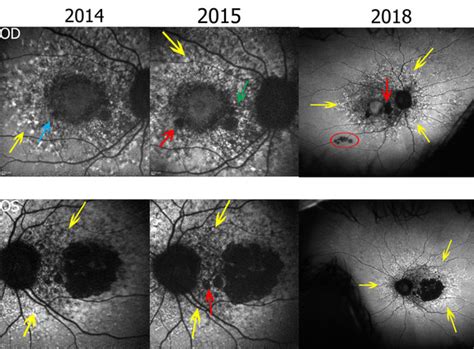 Stargardt Disease 4 Year Follow Up Of Geographic Atrophy The Retina