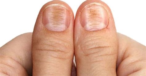 Nail Ridges Causes Types And How To Cure Naildesigncode