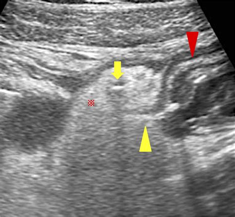 Transabdominal Ultrasound Sonography Findings In Peritonitis Due To The