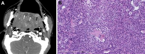 Myoepithelial Carcinoma Of The Salivary Gland Pathologic And Ct