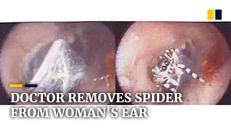 Chinese Doctor Removes Spider That Had Been In Womans Ear For A Week