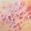 Viral Skin Conditions Pictures Of Rashes Blisters And Sores In 