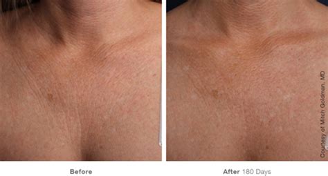 New Treatment Area Approved For Ultherapy Advanced Dermatology Blog