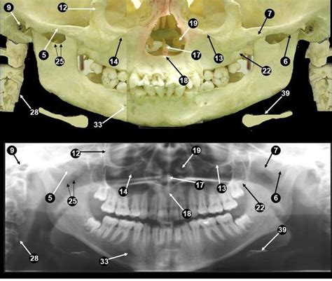 Anatomical Landmarks Of Panoramic Radiographs Dental Assistant Study