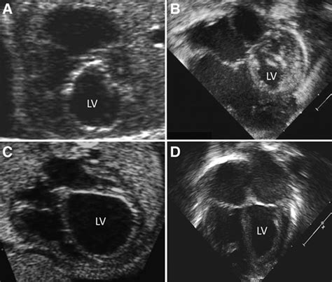 Fetal Aortic Valvuloplasty For Evolving Hypoplastic Left Heart Syndrome
