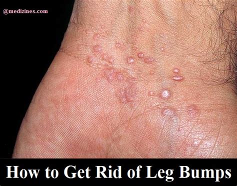 How To Get Rid Of Heat Rash Bumps On Arms