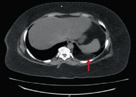 Computed Tomography Ct Scan Of The Abdomen Showing A 16 Cm