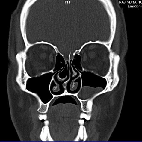 Infected Sinus Ct Scan