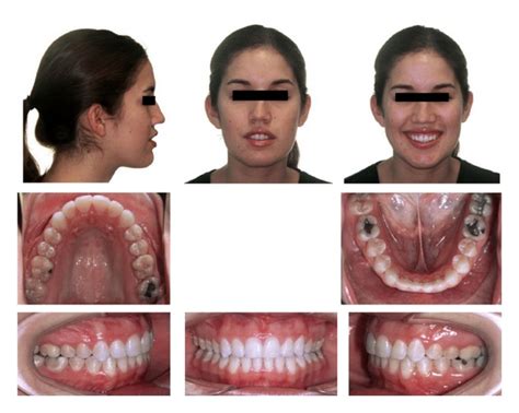 Adult Maxillary Protraction A Case Study Face Pulling Improve