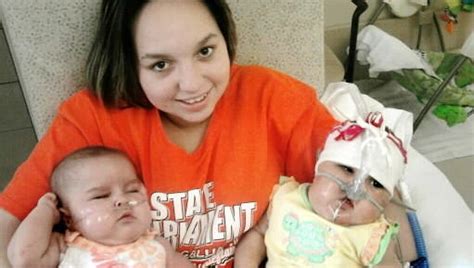 Formerly Conjoined Oklahoma Twins Released From Hospital