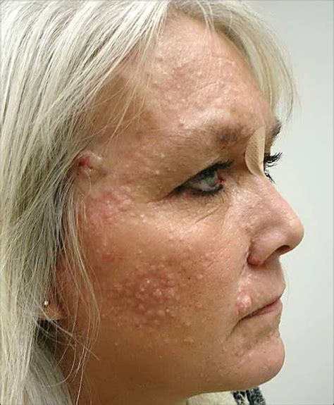 numerous facial lesions in a 47 year old woman—quiz case dermatology jama dermatology jama