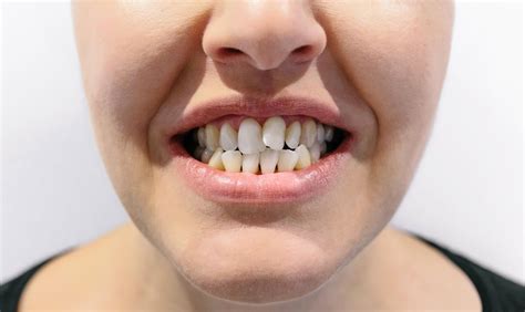 What Causes Crooked Teeth Village Square Dental