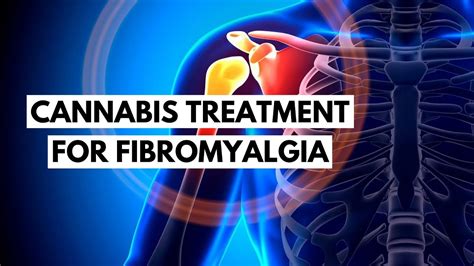 Cannabis Treatment For Fibromyalgia Youtube