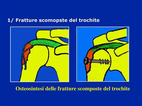 PPT - Lussazioni di spalla PowerPoint Presentation - ID ...