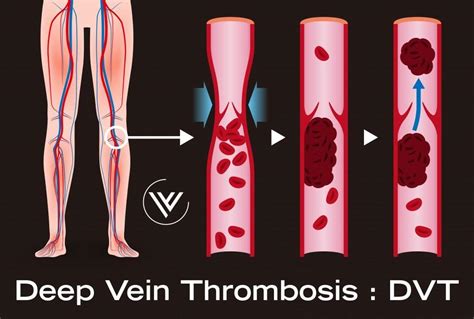Are Superficial Thrombophlebitis And Deep Vein Thrombosis Treated The