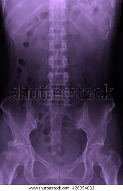 Xray Acute Abdomen Series Abdominal Spinal Stock Photo 428354032