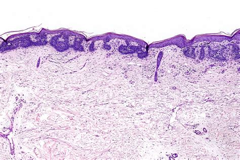Basal Cell Carcinoma Histology Health Pictures Basal Cell Carcinoma