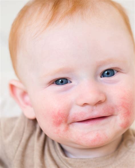 Understanding Eczema In Kids — The Pediatrician Mom