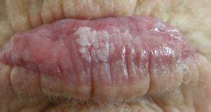 A bump can form on the roof of the mouth due to many conditions, including canker sores, mucoceles, torus palatinus, and oral candidiasis. White patches on lips from leukoplakia | White patches, Zits, Patches
