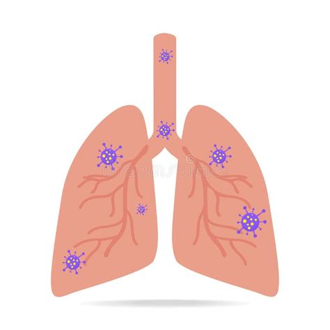 Virus And Bacteria Infected The Human Lungs Stock Illustration
