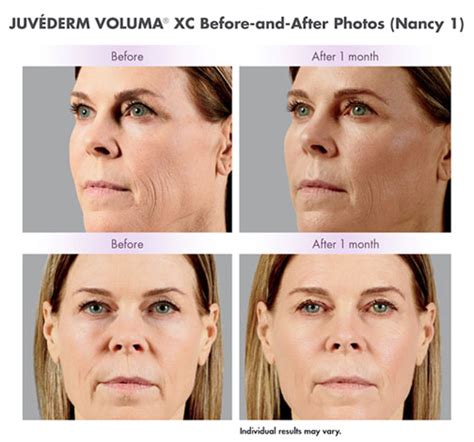 Juvederm Voluma Xc Cheek Fillers At Allure Cosmetic Surgery