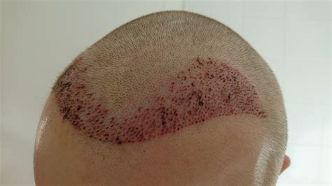 Fue Post Op Pictures Day Hair Transplant Story