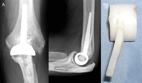 Macroscopic Investigation Of Failed Kudo Type 5 Total Elbow