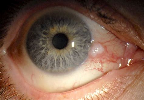 Pathology Outlines Conjunctival Intraepithelial Neoplasia