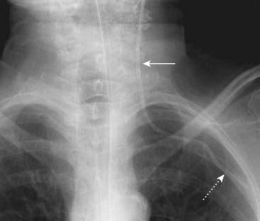 Recognizing The Correct Placement Of Lines And Tubes Radiology Key