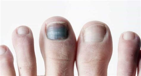 A Black Spot Under The Toenail What Is It Feet First Clinic