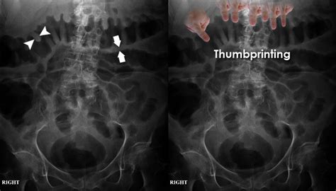 Abdominal X Ray Abnormal Bowel Gas Pattern Bowel Wall Inflammation