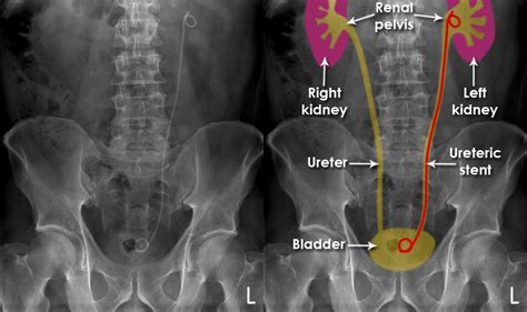 Abdominal X Ray Artifacts Renal And Ureteric Stents