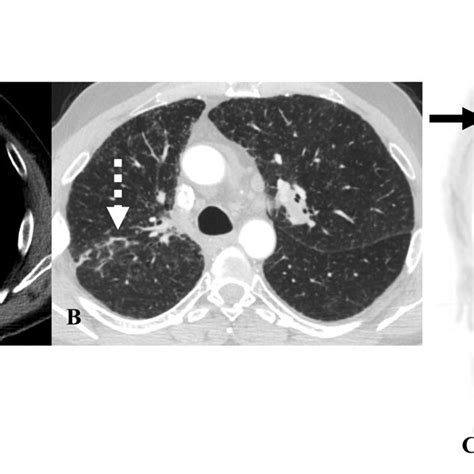 Sarcoidosis Like Reaction A B Contrast Enhanced Axial Chest CT Images